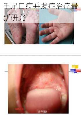 手足口病并发症治疗最新研究