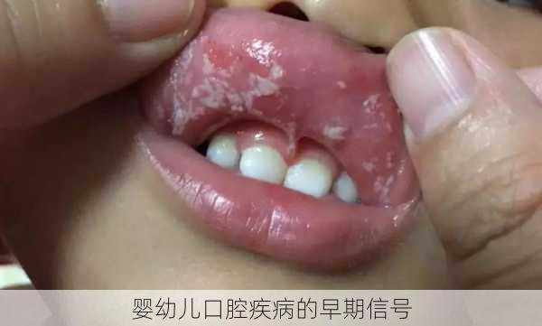 婴幼儿口腔疾病的早期信号