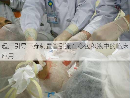 超声引导下穿刺置管引流在心包积液中的临床应用