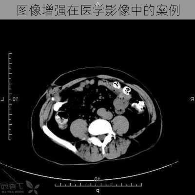 图像增强在医学影像中的案例