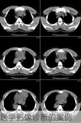 医学影像诊断的案例