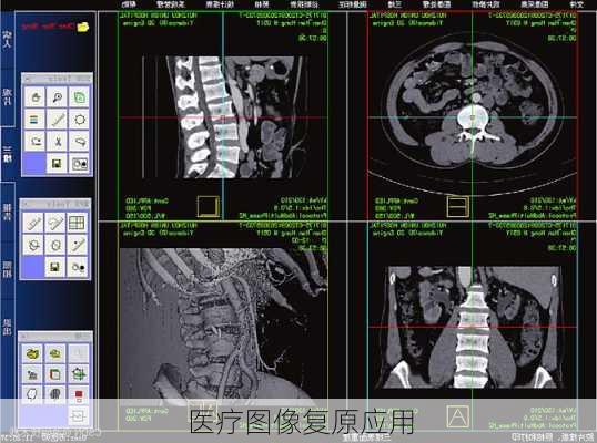 医疗图像复原应用