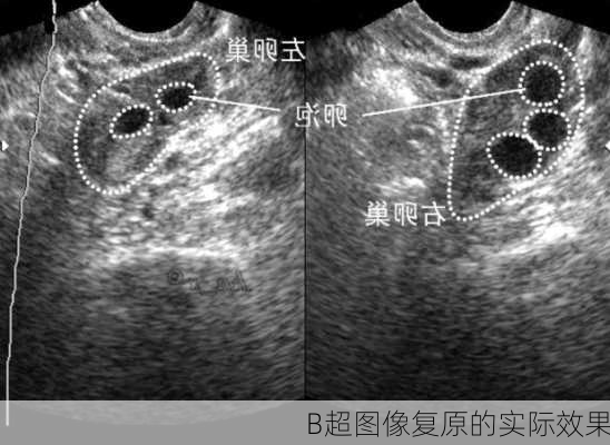 B超图像复原的实际效果