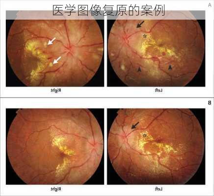 医学图像复原的案例