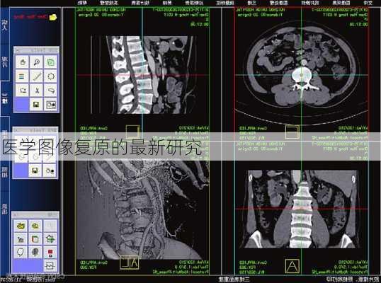 医学图像复原的最新研究