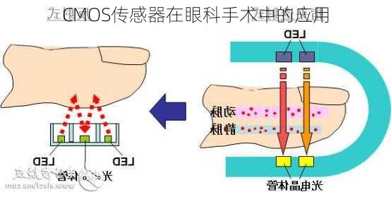 CMOS传感器在眼科手术中的应用