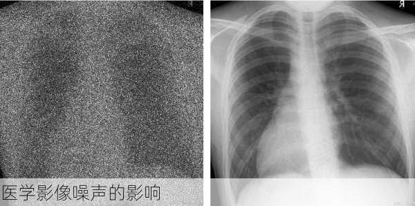 医学影像噪声的影响