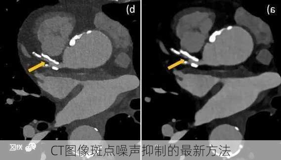 CT图像斑点噪声抑制的最新方法