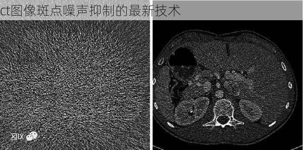 ct图像斑点噪声抑制的最新技术