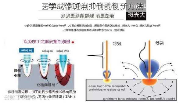 医学成像斑点抑制的创新方法