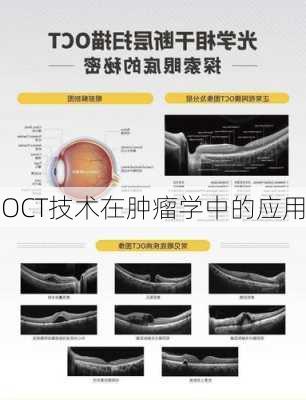 OCT技术在肿瘤学中的应用