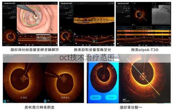 oct技术治疗范围