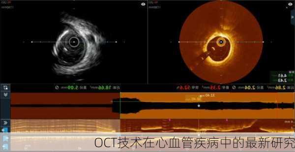 OCT技术在心血管疾病中的最新研究