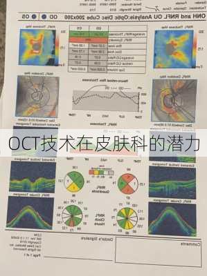 OCT技术在皮肤科的潜力