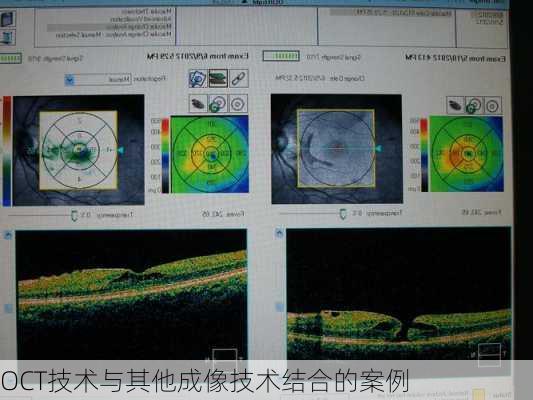 OCT技术与其他成像技术结合的案例