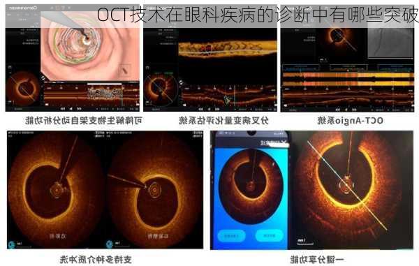 OCT技术在眼科疾病的诊断中有哪些突破