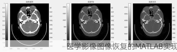 医学影像图像恢复的MATLAB实现