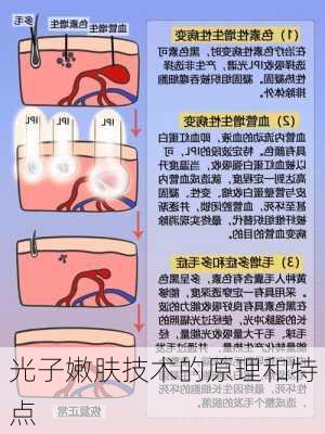 光子嫩肤技术的原理和特点