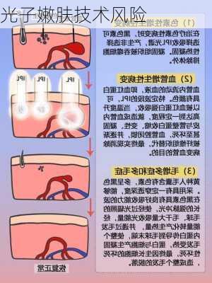 光子嫩肤技术风险