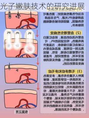 光子嫩肤技术的研究进展