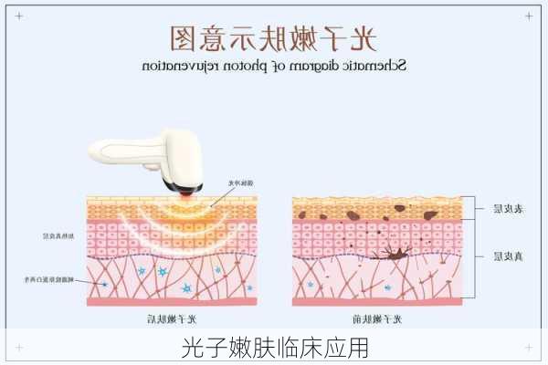 光子嫩肤临床应用