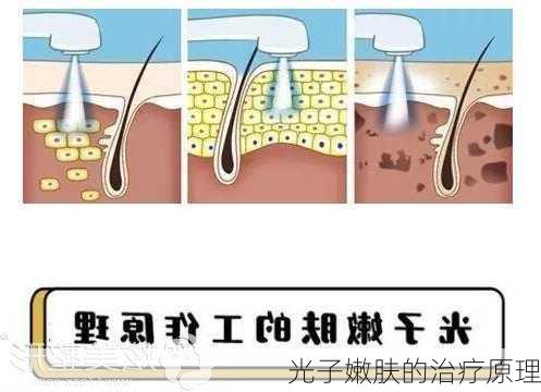 光子嫩肤的治疗原理