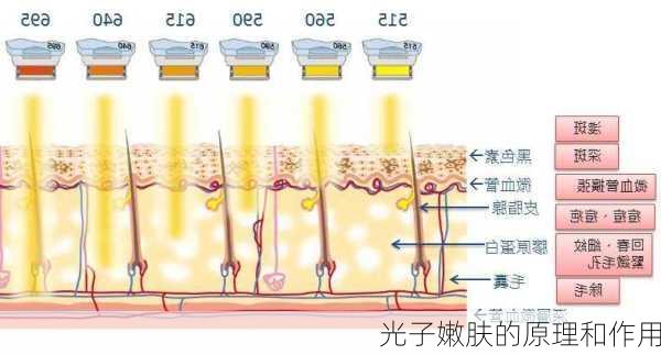 光子嫩肤的原理和作用