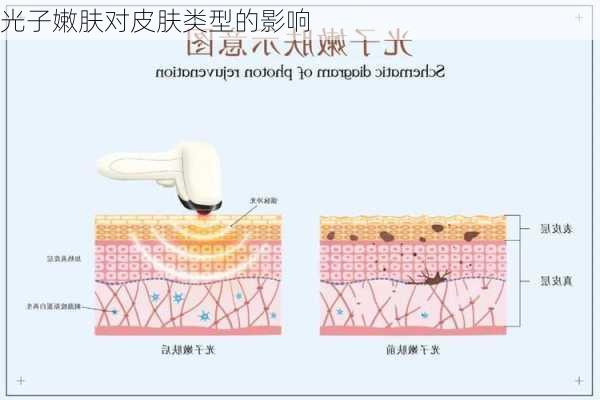 光子嫩肤对皮肤类型的影响