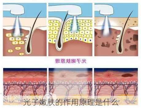 光子嫩肤的作用原理是什么